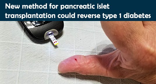 New method for pancreatic islet transplantation could reverse type 1 diabetes