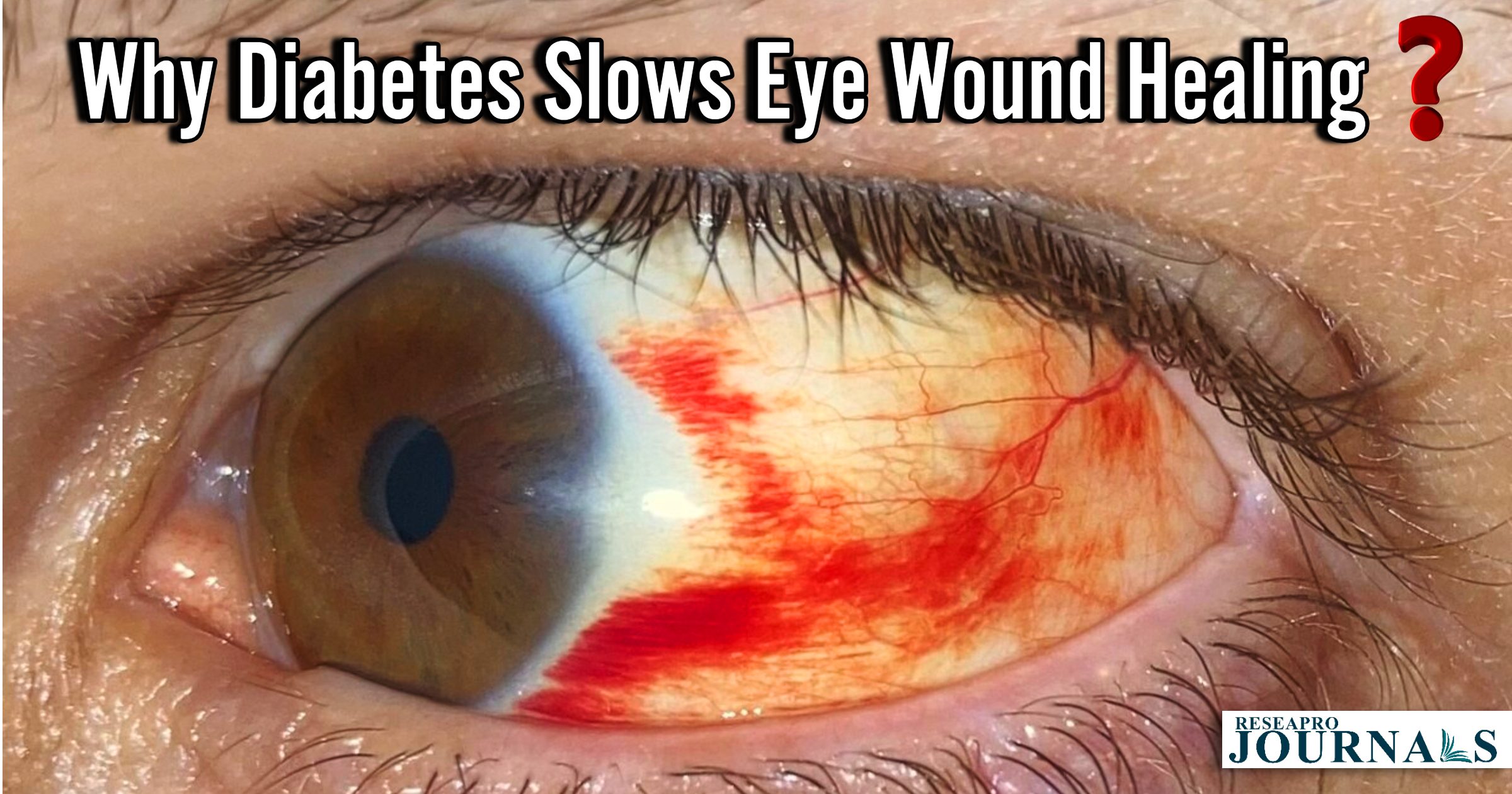 Why Diabetes Slows Eye Wound Healing?