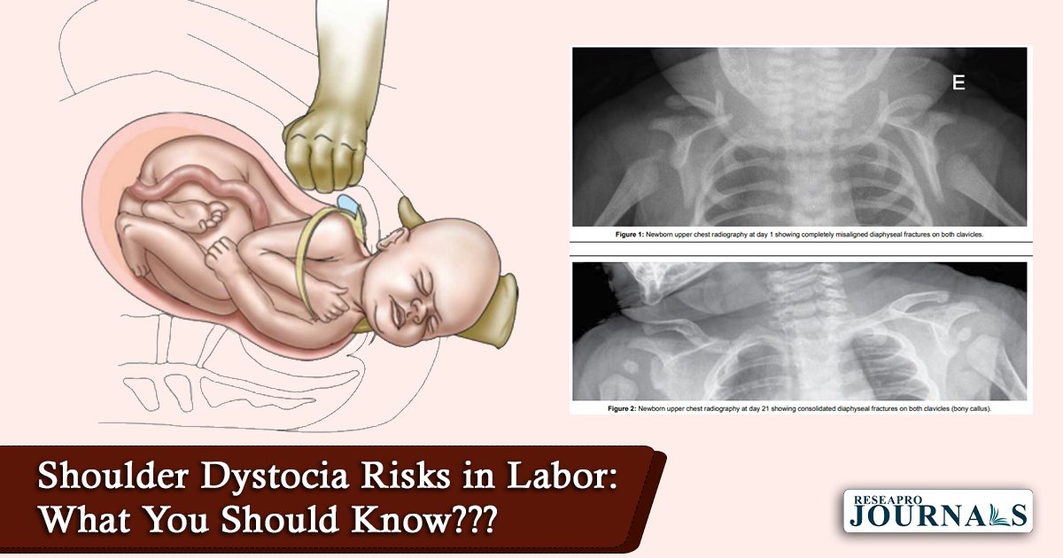Shoulder Dystocia Risks in Labor: What You Should Know???