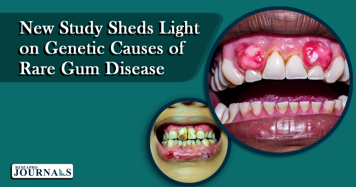 New Study Sheds Light on Genetic Causes of Rare Gum Disease
