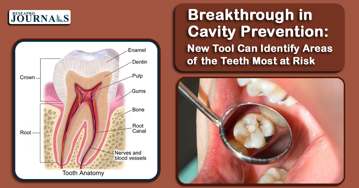 Breakthrough in Cavity Prevention: New Tool Can Identify Areas of the Teeth Most at Risk