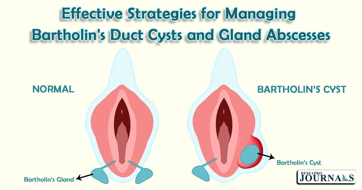 Effective Strategies for Managing Bartholin’s Duct Cysts and Gland Abscesses