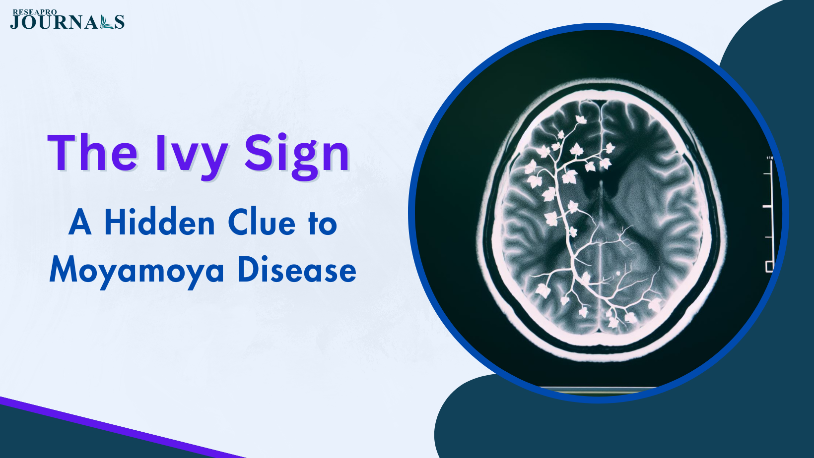 The Ivy Sign: A Hidden Clue to Moyamoya Disease