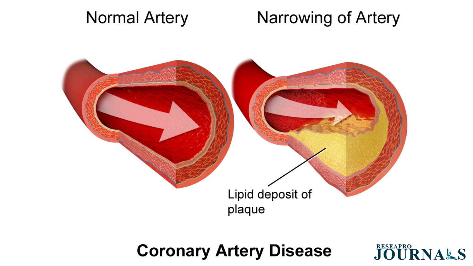 Bioinformatics Insights: Diagnostic Markers in Atherosclerosis