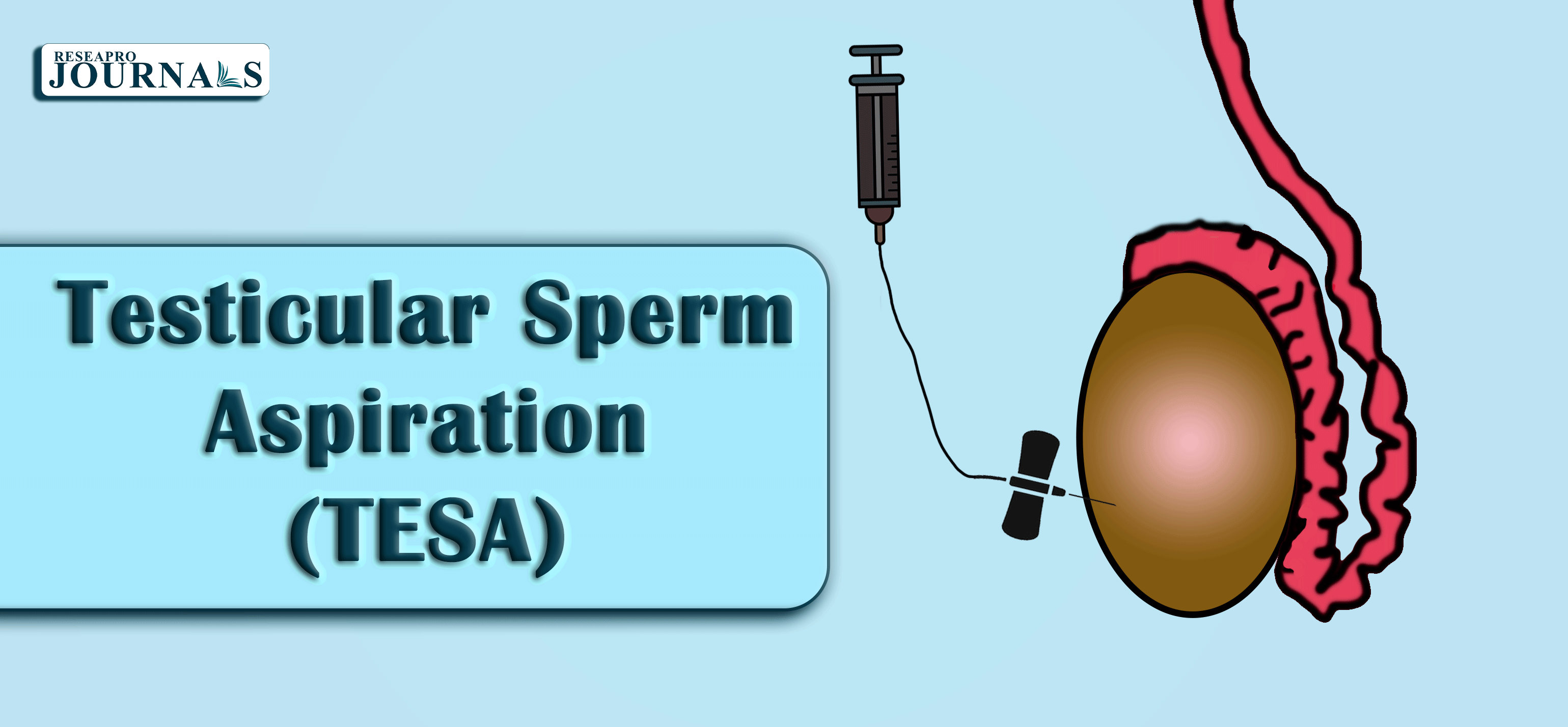 TESA: Direct testicular sperm retrieval for IVF with minimal invasiveness