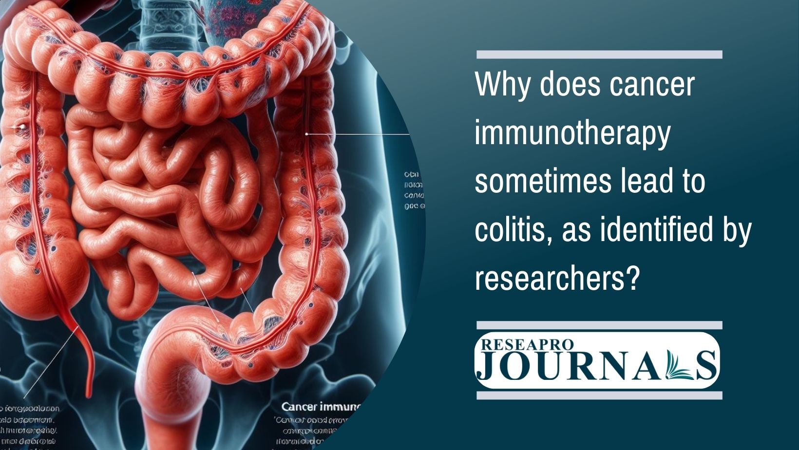 Cancer immunotherapy’s immune activation may cause colitis—research aims for solutions.