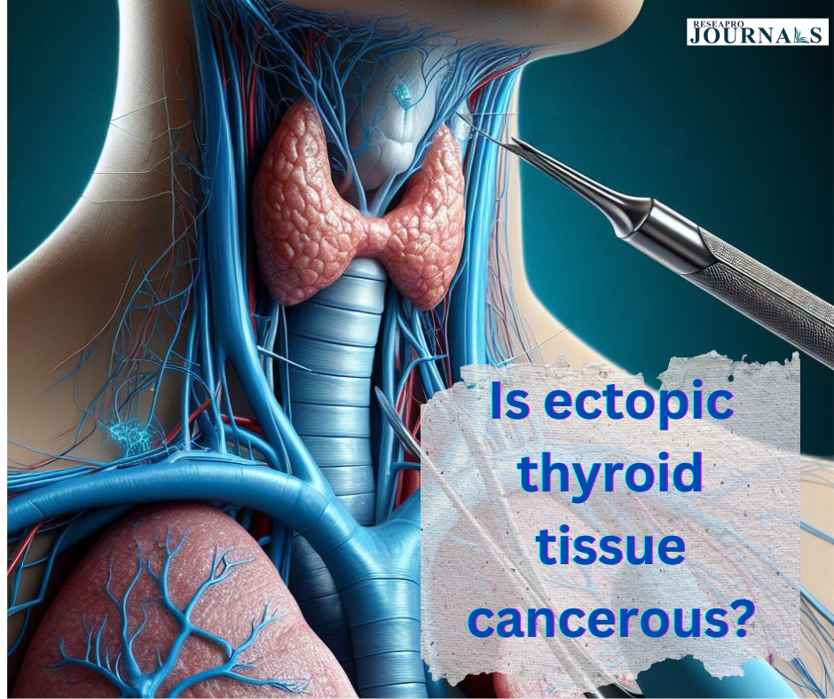Is ectopic thyroid tissue cancerous?